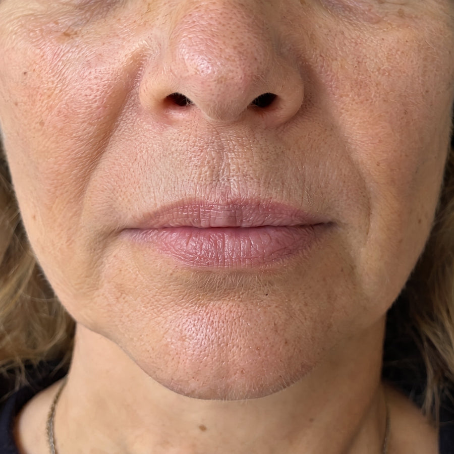 Contour de la bouche après la cure, ridules atténuées