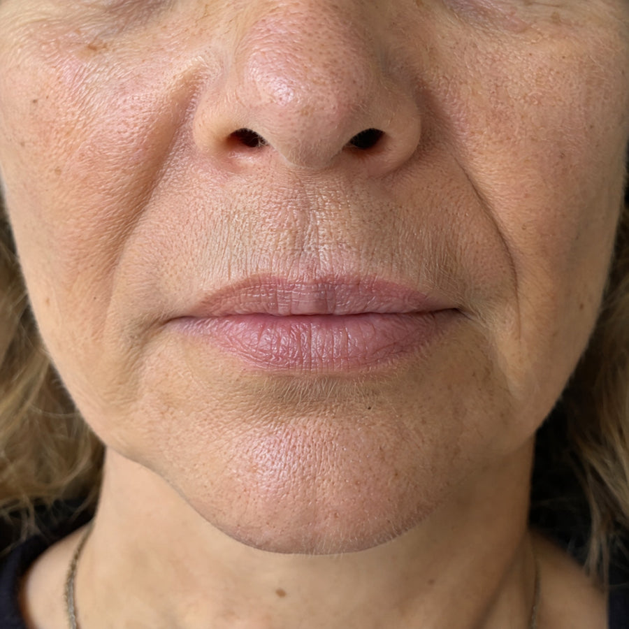 Contour de la bouche avant la cure, ridules au-dessus de la lèvre