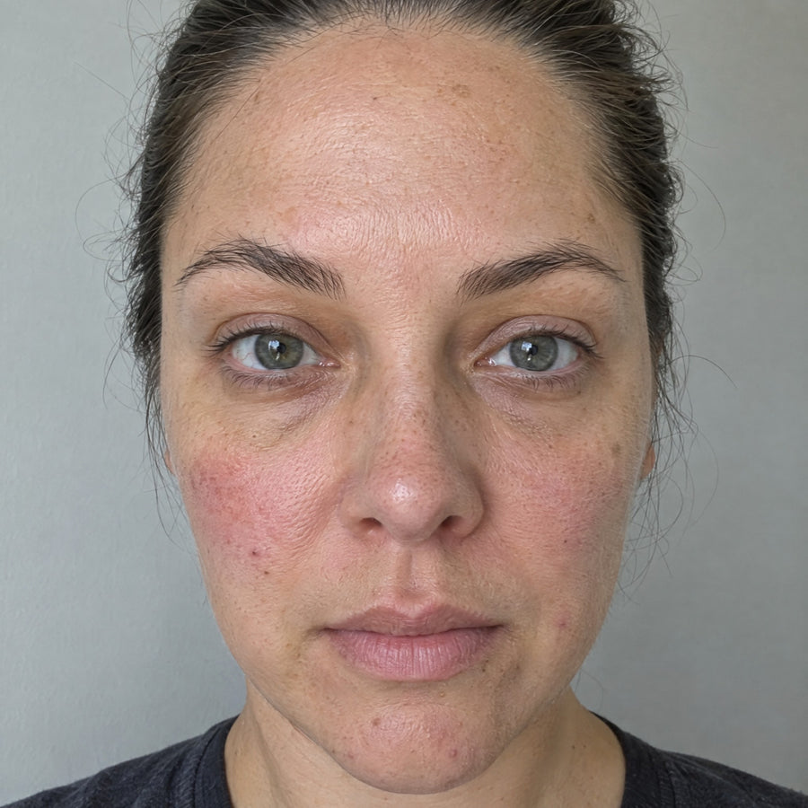 Visage avant la cure, teint fatigué et irrégulier